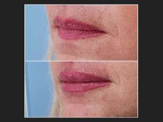 Hijaluronska kiselina – fileri 16