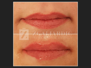 Hijaluronska kiselina fileri 18