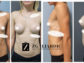 Povećanje grudi 3/2024-001