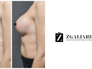 Povećanje grudi 3/2024-002