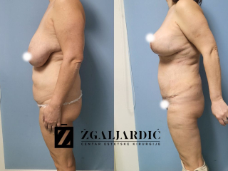 Povećanje grudi 3/2024-003